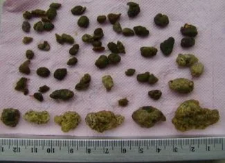 Čišćenje jetre procedura