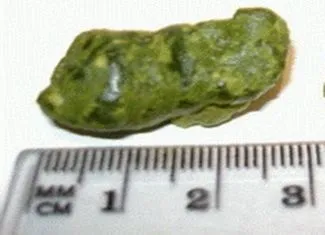 Kamenci iz jetre i žučne vrećice