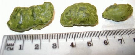 Kamenci iz jetre i žučne vrećice