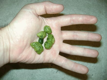 Kamenci iz jetre i žučne vrećice