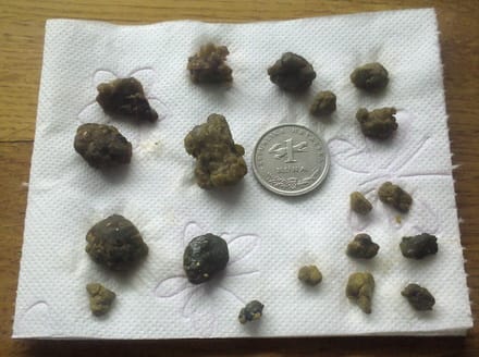 Kamenci iz jetre i žučne vrećice