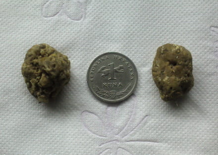 Kamenci iz jetre i žučne vrećice