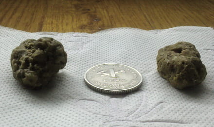 Kamenci iz jetre i žučne vrećice