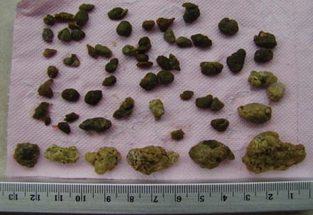 Kamenci iz jetre i žučne vrećice